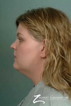 Liposuction: Patient 5 - Before and After Image 2