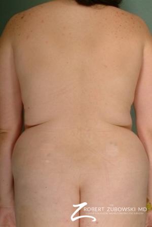 Liposuction: Patient 2 - Before Image 1