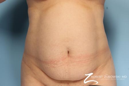 Tummy Tuck: Patient 20 - Before Image 1