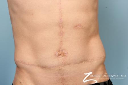 Scar Revision: Patient 2 - After Image 1