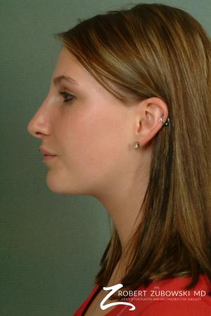 Rhinoplasty: Patient 2 - After Image 2