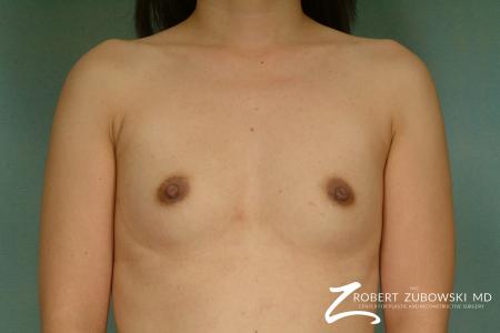 Breast Augmentation: Patient 25 - Before Image 1