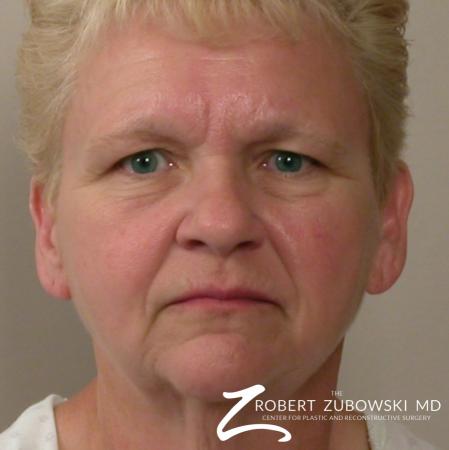 Facelift: Patient 14 - Before Image 1