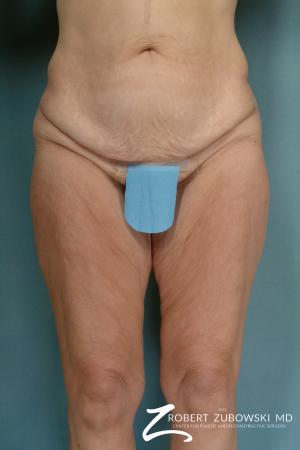 Body Lift: Patient 2 - Before Image 1