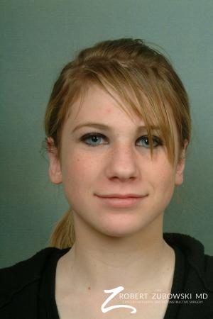 Otoplasty: Patient 5 - After Image 1