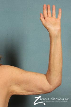 Arm Lift: Patient 2 - Before Image 1