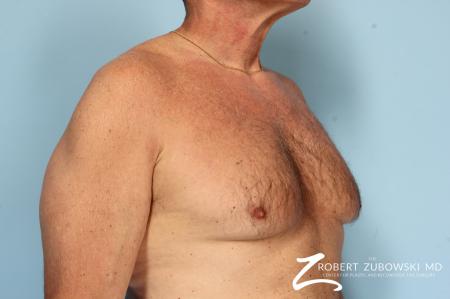 Gynecomastia: Patient 12 - Before and After Image 2