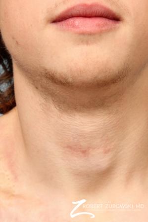 Scar Revision: Patient 3 - After Image 1