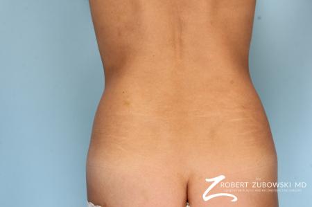 CoolSculpting®: Patient 6 - Before Image 1