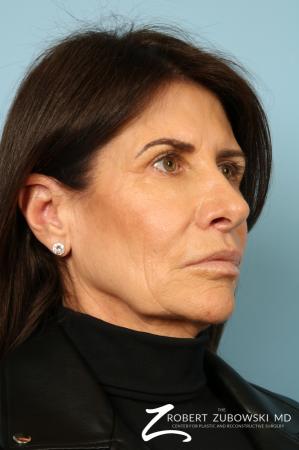 Lip Augmentation: Patient 1 - After Image 3