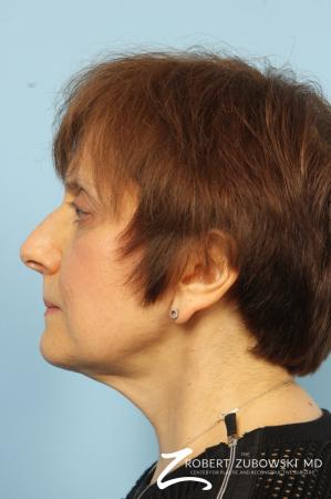 Blepharoplasty: Patient 14 - After Image 3