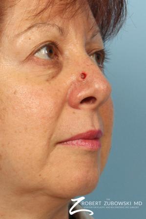 Mohs Closure: Patient 2 - Before Image 1