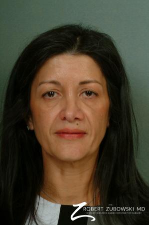 Brow Lift: Patient 5 - Before Image 1