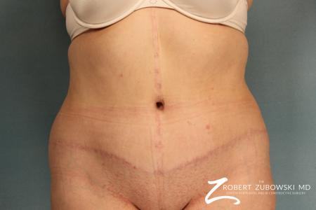 Tummy Tuck: Patient 11 - After Image 1