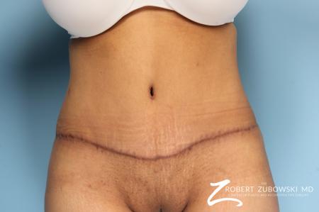Tummy Tuck: Patient 15 - After Image 1
