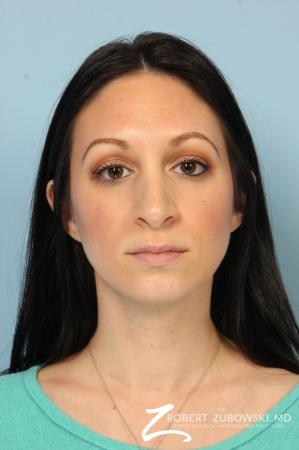 Rhinoplasty: Patient 25 - Before Image 1