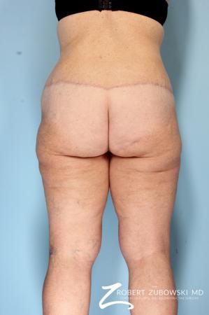 Body Lift: Patient 5 - After Image 2