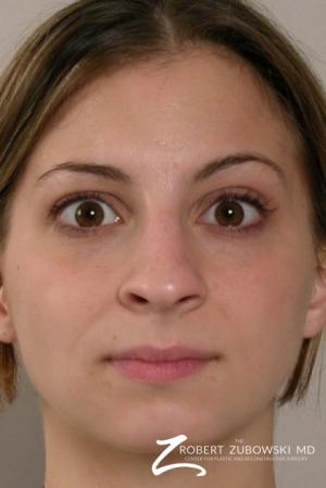 Rhinoplasty: Patient 6 - Before Image 1
