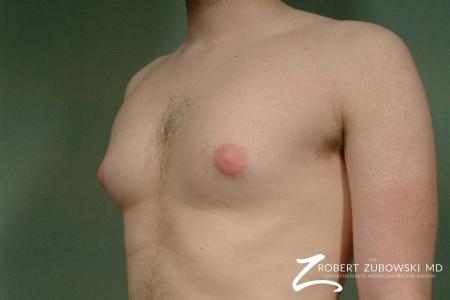 Gynecomastia: Patient 4 - Before and After Image 2