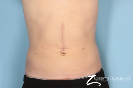 Liposuction: Patient 16 - After Image 1