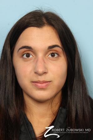 Rhinoplasty: Patient 24 - After Image 1