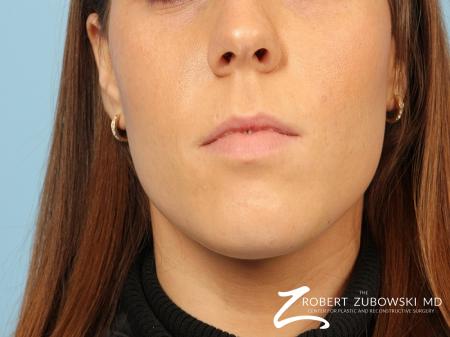 Permanent Lip Enhancement: Patient 2 - Before Image 1
