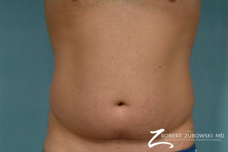 Liposuction: Patient 30 - Before Image 1