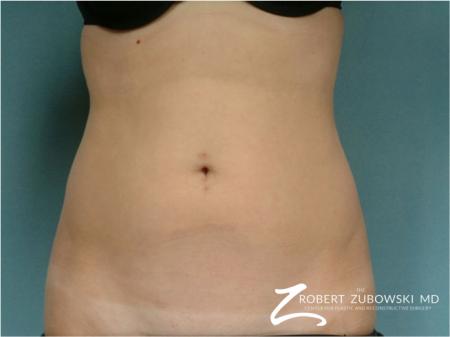 Liposuction: Patient 39 - Before Image 1