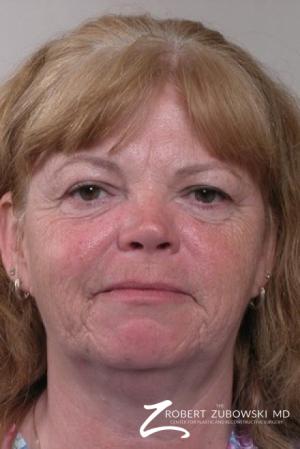 Facelift: Patient 4 - Before Image 1
