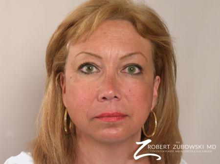 Blepharoplasty: Patient 19 - Before Image 1