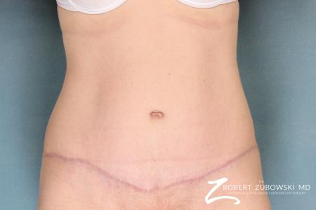 Tummy Tuck: Patient 4 - After Image 1