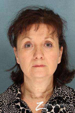 Facelift: Patient 22 - Before Image 1