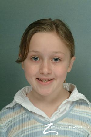 Otoplasty: Patient 1 - After Image 1