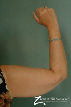 Liposuction: Patient 23 - Before and After Image 2