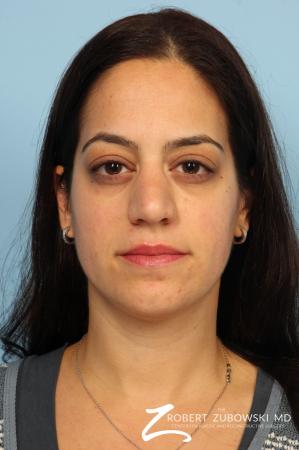 Rhinoplasty: Patient 15 - Before Image 1