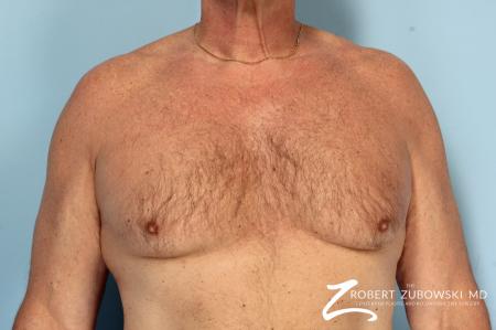 Gynecomastia: Patient 12 - Before Image 1