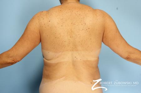CoolSculpting®: Patient 2 - After Image 3