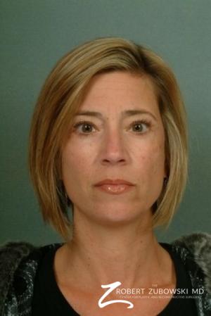 Blepharoplasty: Patient 10 - After Image 1
