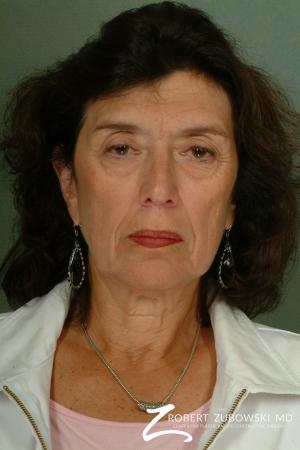 Brow Lift: Patient 6 - Before Image 1