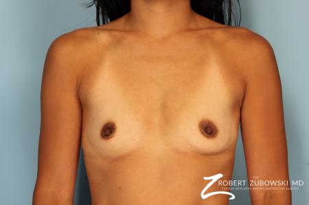 Breast Augmentation: Patient 2 - Before Image 1