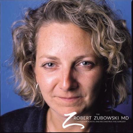 BOTOX® Cosmetic: Patient 1 - After Image 1