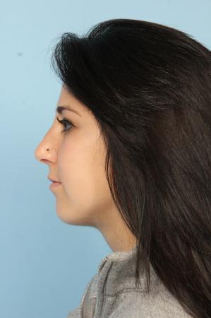 Rhinoplasty: Patient 20 - After Image 2