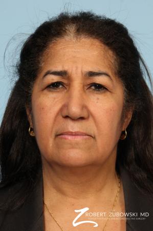 Brow Lift: Patient 8 - Before Image 1