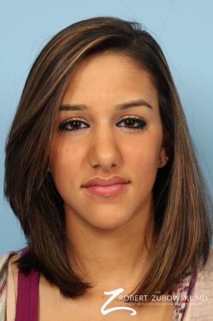 Rhinoplasty: Patient 14 - After Image 1
