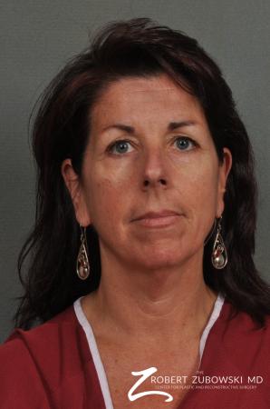 Neck Lift: Patient 4 - Before Image 1