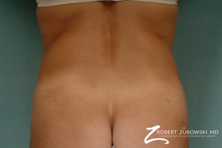 Liposuction: Patient 33 - After Image 3