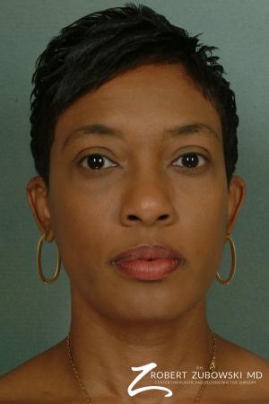 Blepharoplasty: Patient 3 - After Image 1
