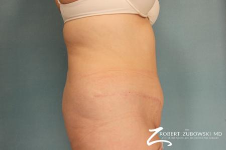 Tummy Tuck: Patient 11 - After Image 2