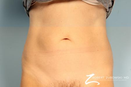 CoolSculpting®: Patient 4 - After Image 1