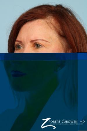 Facelift: Patient 29 - After Image 3